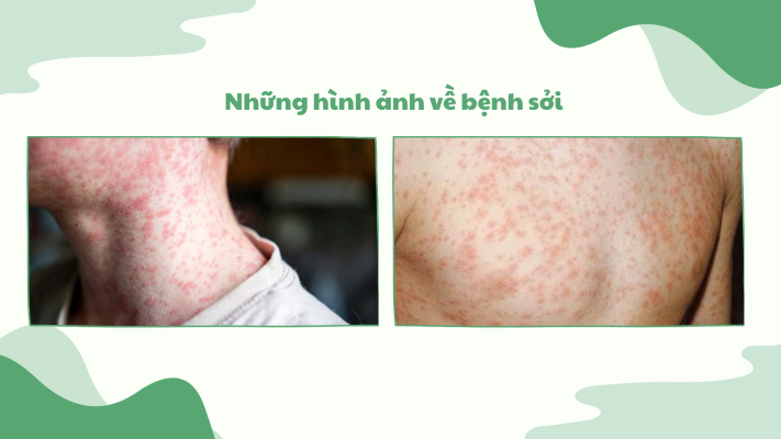 bệnh sởi ở trẻ em